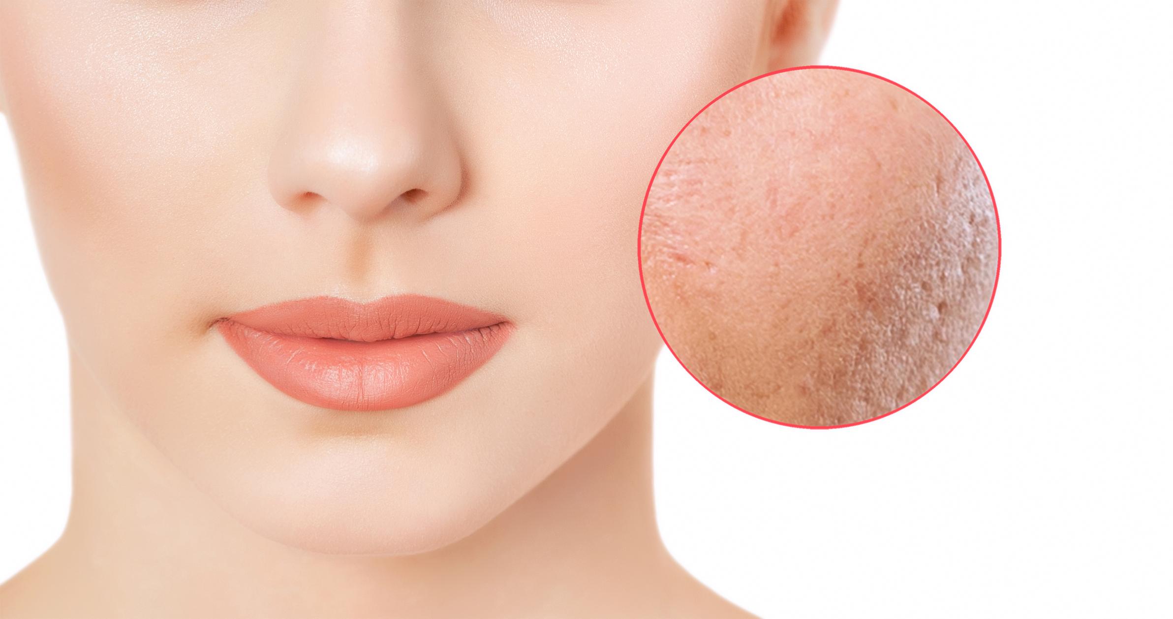 Unveiling the Power of ProFractional Laser: Your Go-To Skin Rejuvenation Solution