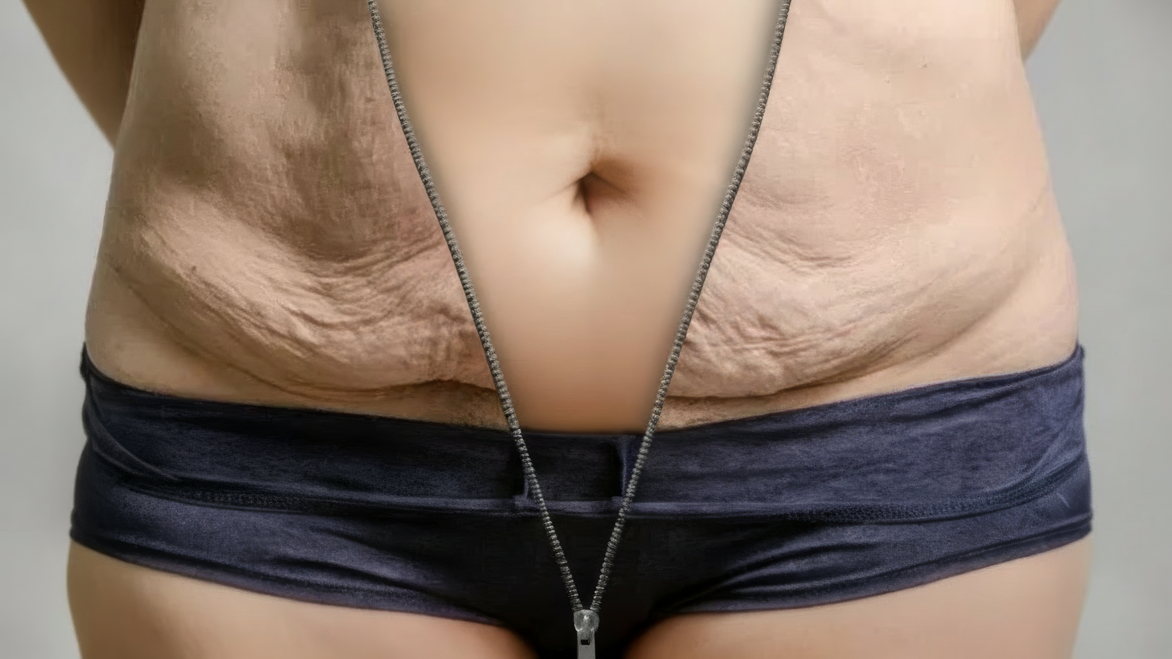 Diastasis Recti