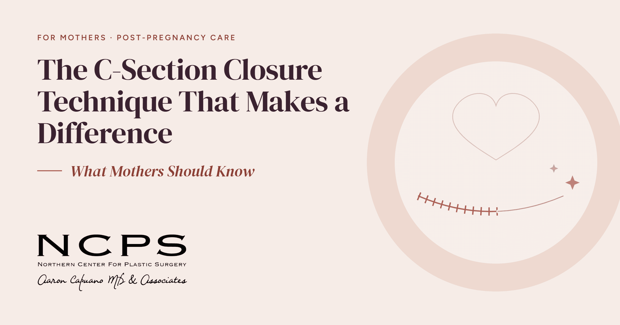 The C-Section Closure Technique That Makes a Difference: What Mothers Should Know