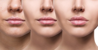 Lip Fillers