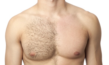 Hair Reduction