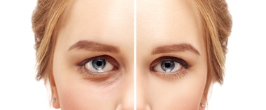 Non surgical eyelid lift