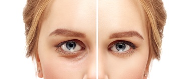 Non Surgical Eyelid Lift