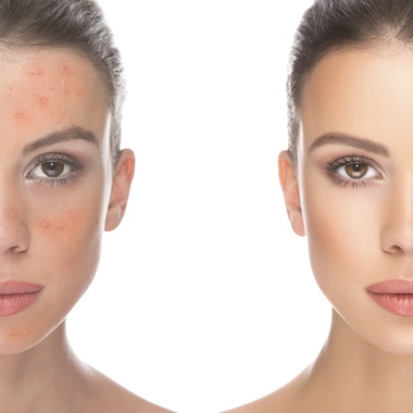 Acne Treatments